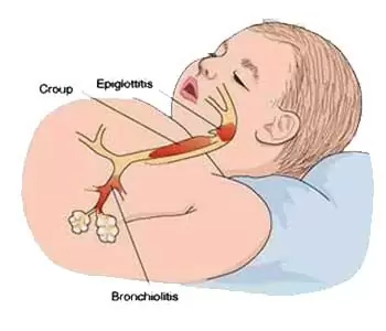 croup cough syndrome