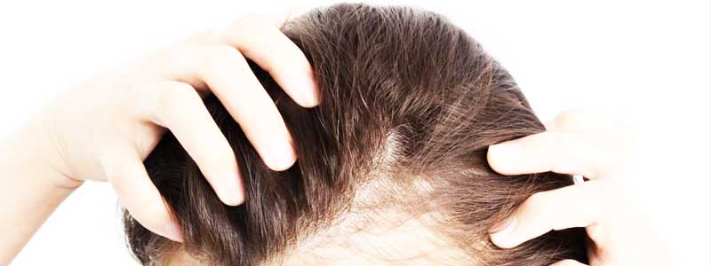 Female Pattern Baldness (Symptoms, Causes, Natural Remedies & Hairstyle)