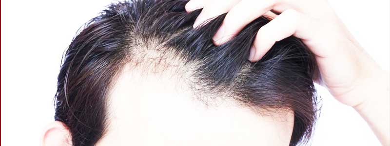 Male Pattern Baldness (Symptoms, Causes, Natural Remedy, and Hairstyle)