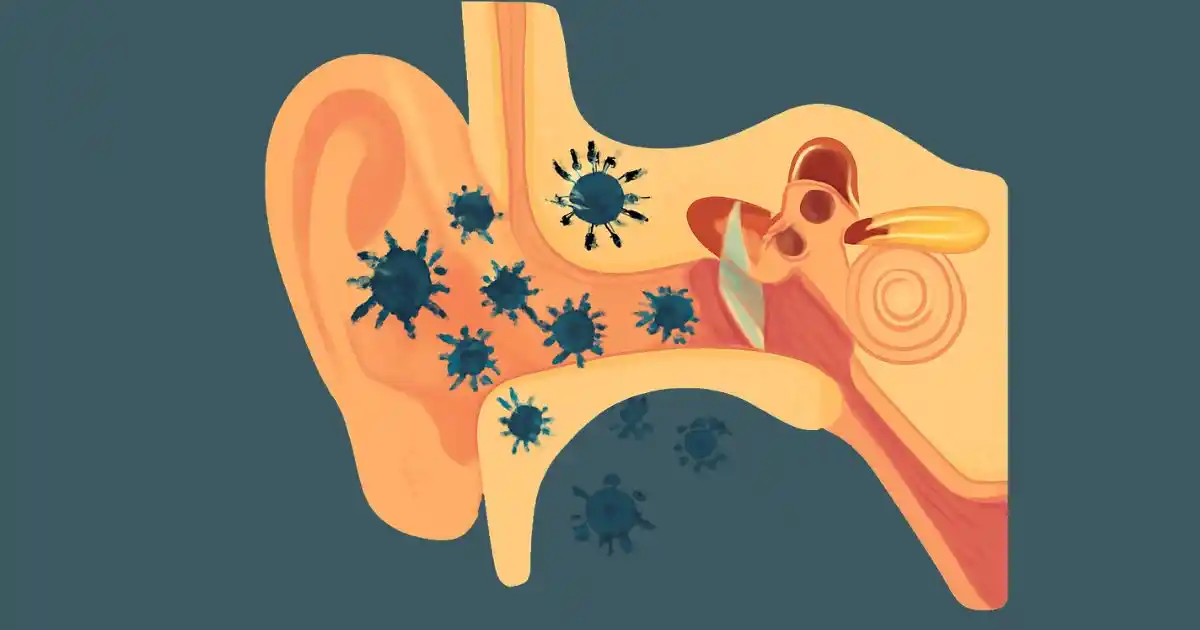 Infected ear canal with bacteria and irritation, caused by earbud use.