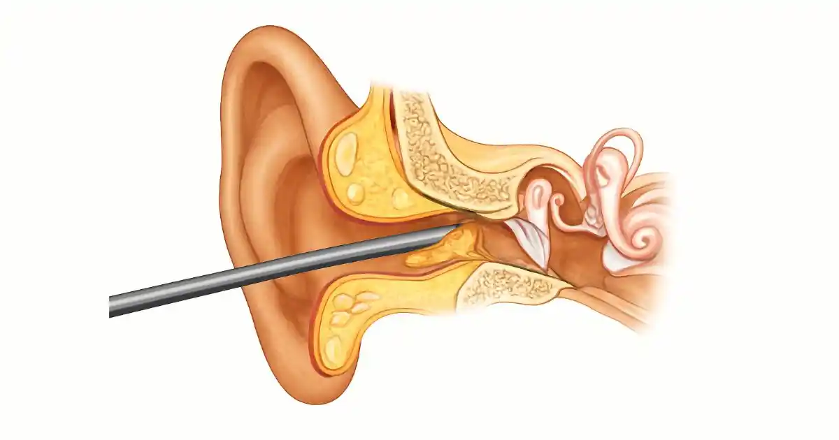 Cross-sectional view of an ear with a metal tool removing earwax, set against a simple backdrop.